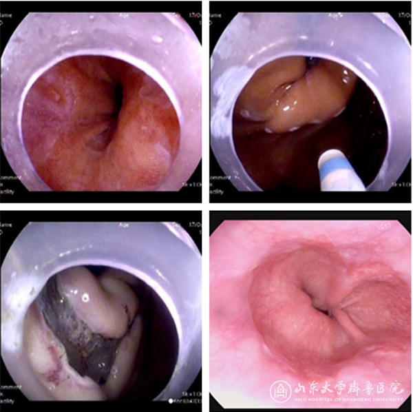我院消化内科首创内镜抗反流黏膜成形术治疗胃食管反流病随访效果满意