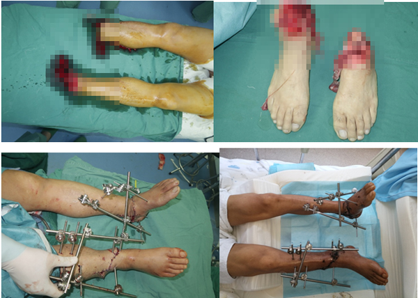 双下肢离断患者在我院成功再植