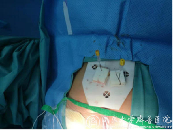 泌尿外科开展3D打印技术引导下骶神经调控术