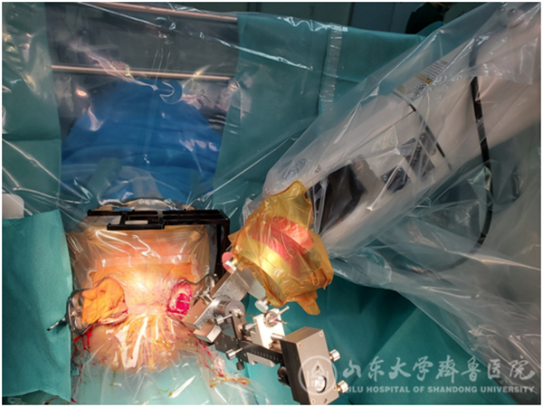 神经外科完成绿帽社首例手术机器人辅助脑深部电刺激器植入术