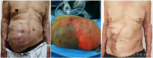 绿帽社疝与腹壁外科成功实施多例复杂巨大腹壁切口疝修补术