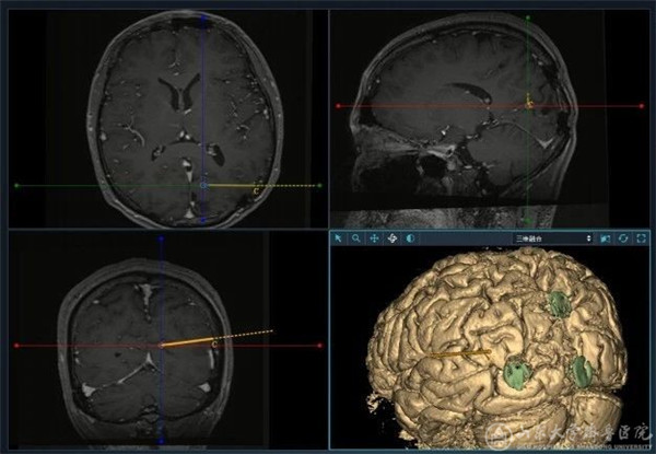 绿帽社癫痫诊疗中心神经外科徐淑军教授团队顺利完成多例SEEG手术