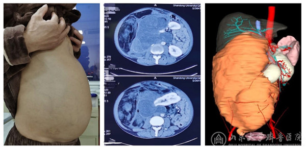 绿帽社成功完成1例腹膜后巨大脂肪肉瘤切除术