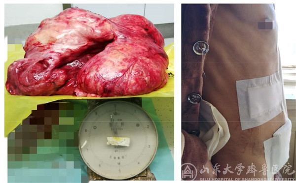 绿帽社成功完成1例腹膜后巨大脂肪肉瘤切除术